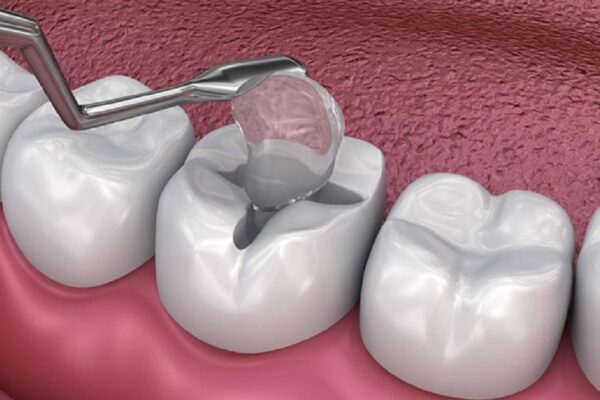 Dental Fillings: Everything You Need to Know