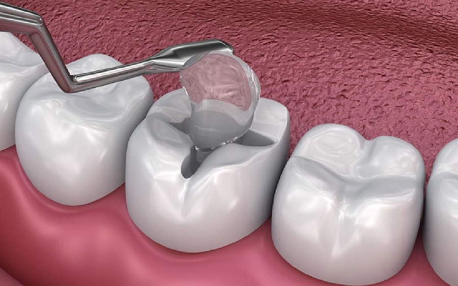 Dental Fillings: Everything You Need to Know