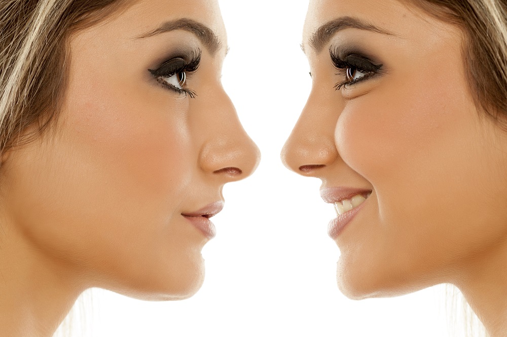 All You Need To Know About Nose Augmentation And Rhinoplasty