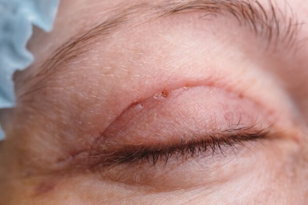 How Blepharoplasty Can Help Open Your Eyes And Make You Look Attractive?