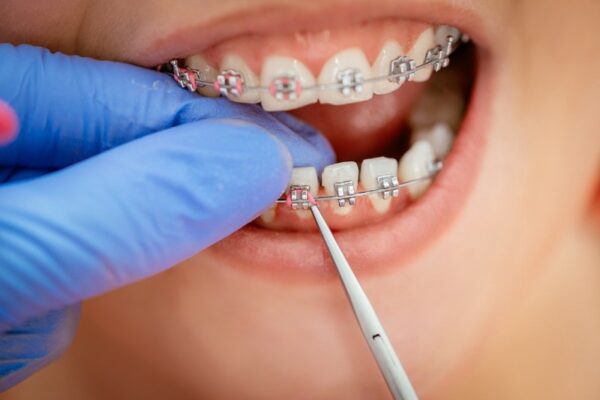Why should you go for Teeth Straightening?