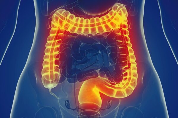 What is Irritable colon or Irritable Bowel Syndrome?