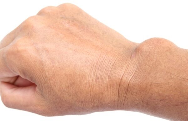 Learn About Ganglion Cyst in Patients in Singapore & Abroad