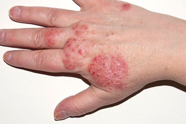 Eczema Explained: 7 Things You Can Relate To If You Have Eczema