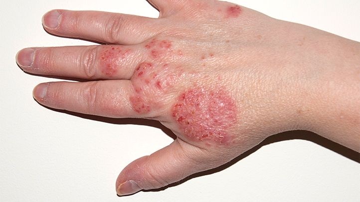 Eczema Explained: 7 Things You Can Relate To If You Have Eczema