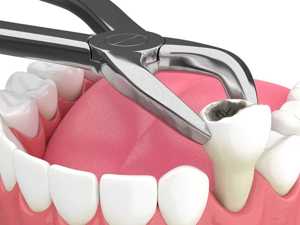 Precautions You Must Take Before Getting Your Tooth Extracted