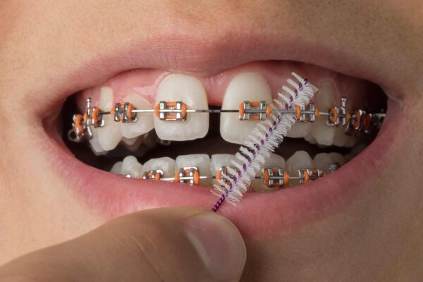 Let Your Teeth Talk: Here Are 6 Reasons You Should Consider Damon Braces In Singapore