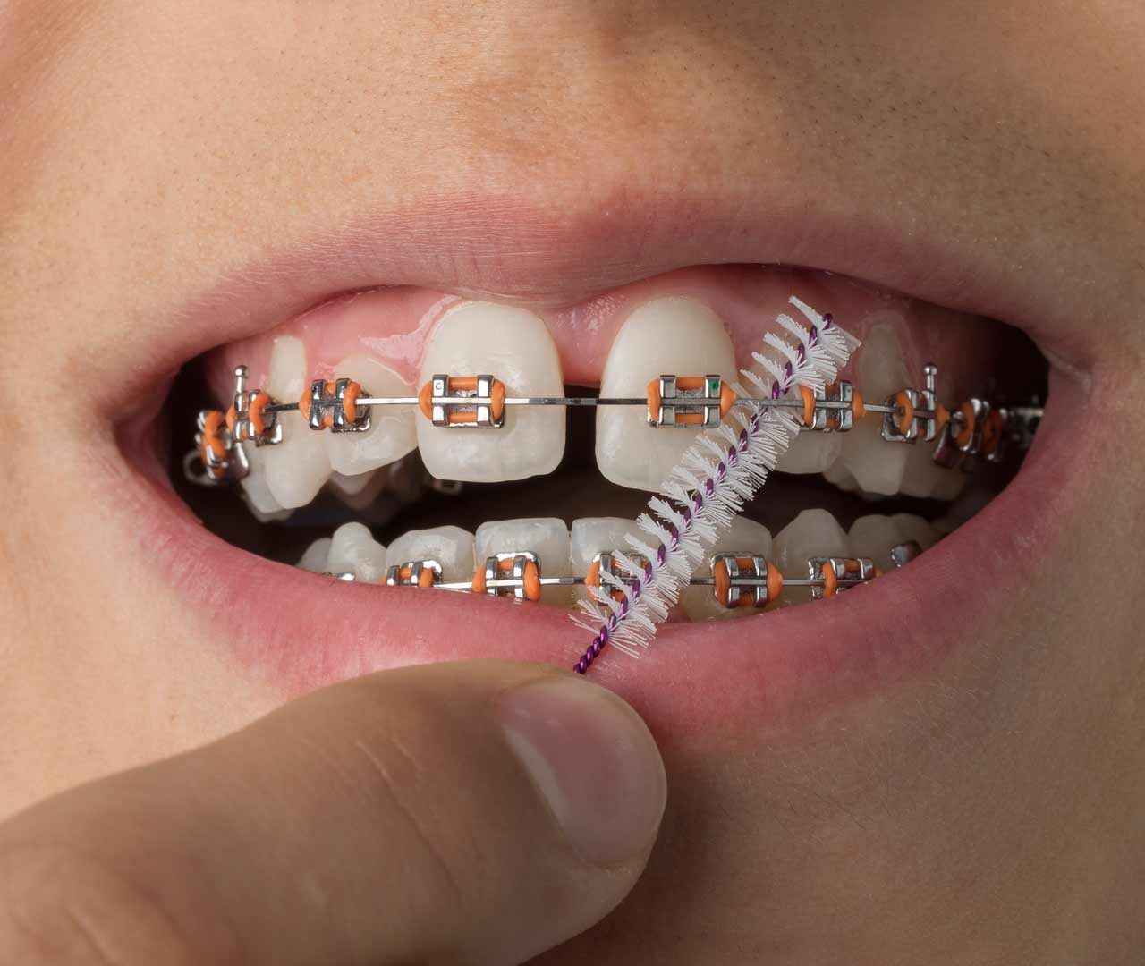 Let Your Teeth Talk: Here Are 6 Reasons You Should Consider Damon Braces In Singapore