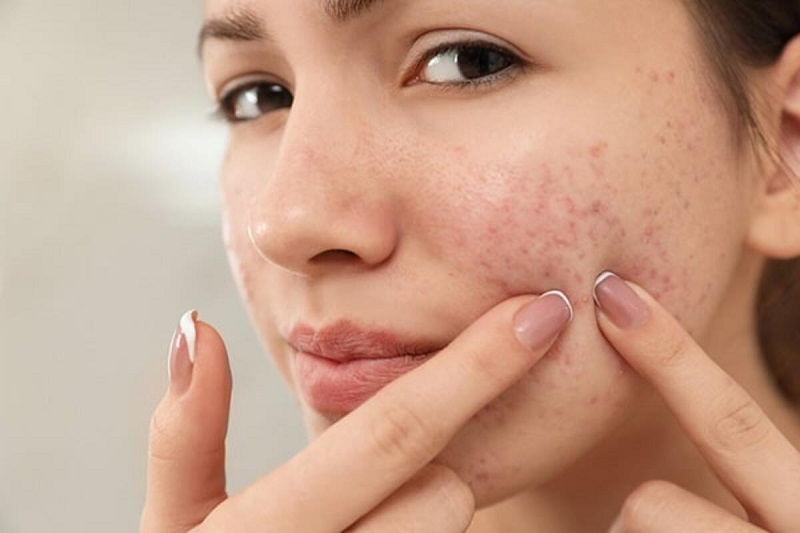 Preventing Pimples Naturally