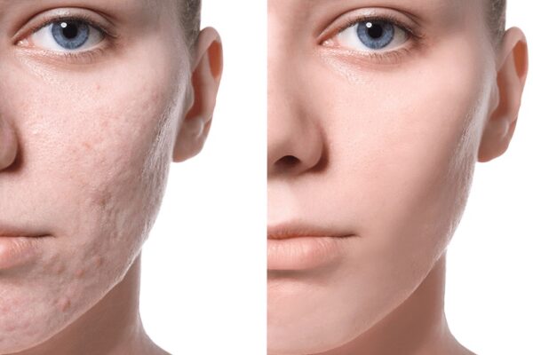 Acne Scar Laser Treatment: Unveiling Flawless Skin