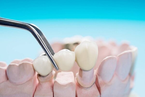 Why Don’t Some Dentists Recommend Dental Bridges? 