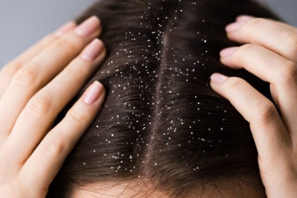 Dandruff or Something Else? When to Switch Your Shampoo or See a Dermatologist