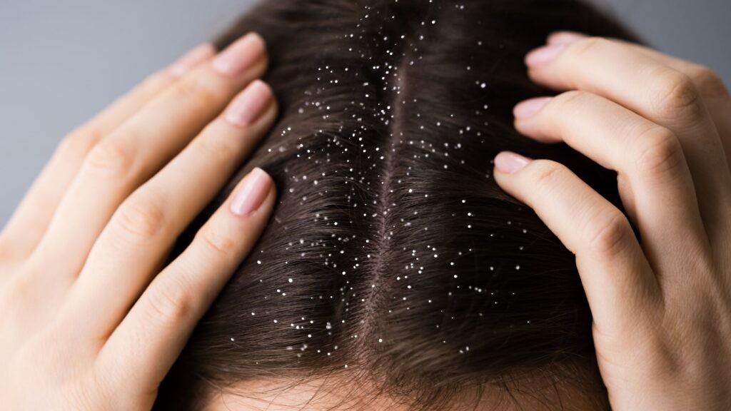 Dandruff or Something Else? When to Switch Your Shampoo or See a Dermatologist