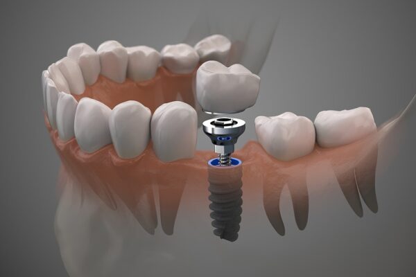 All-on-4 Dental Implants in Culver City: A Comprehensive Treatment Guide