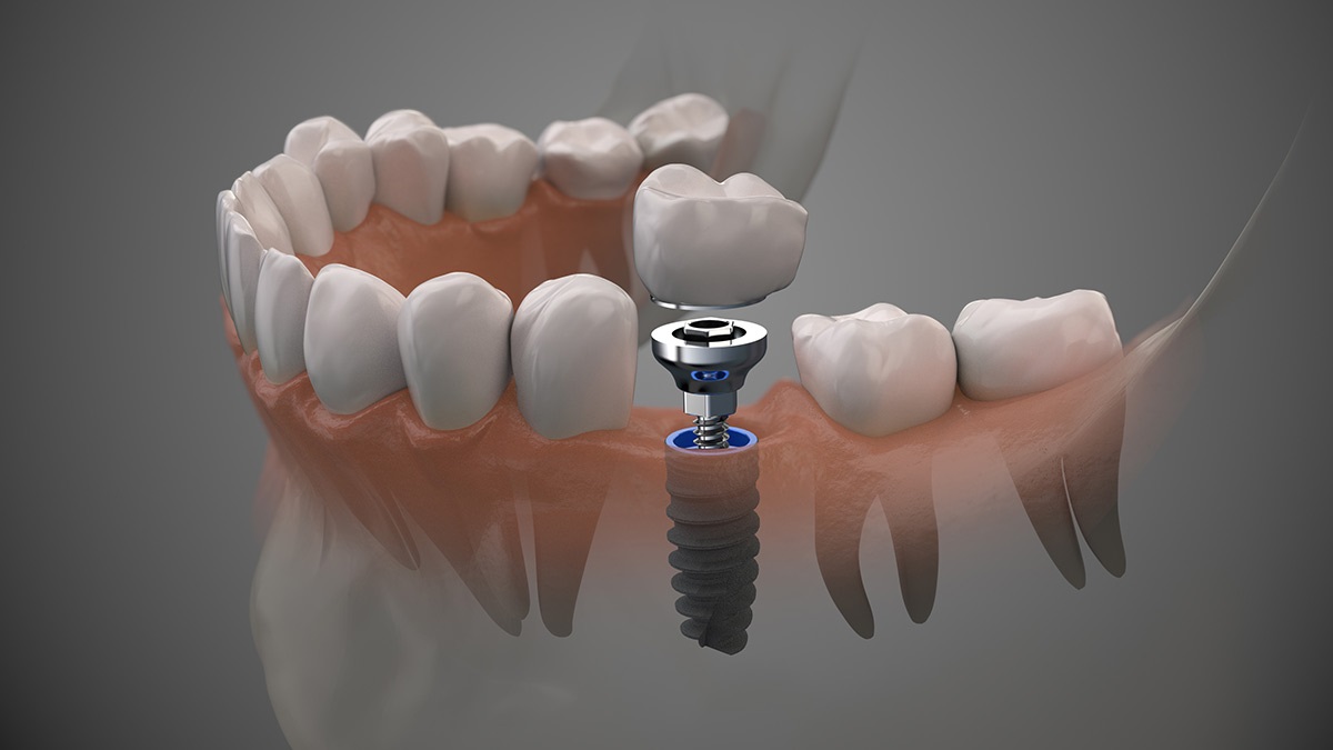 All-on-4 Dental Implants in Culver City: A Comprehensive Treatment Guide