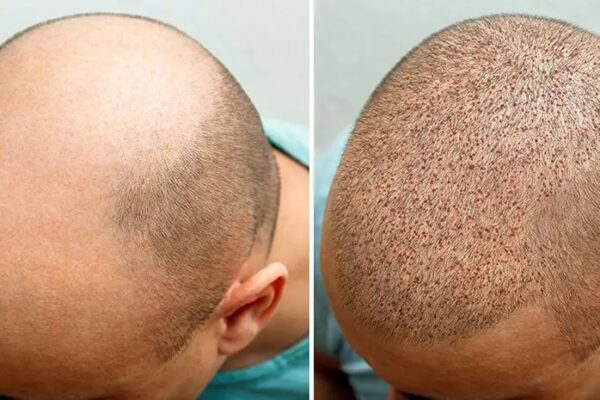 The Importance Of Realistic Expectations Before Hair Transplant Surgery