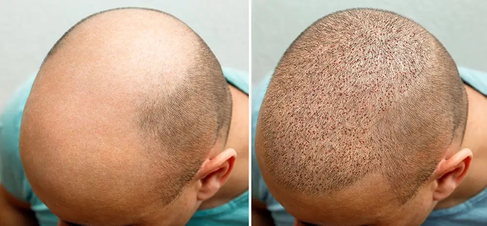The Importance Of Realistic Expectations Before Hair Transplant Surgery